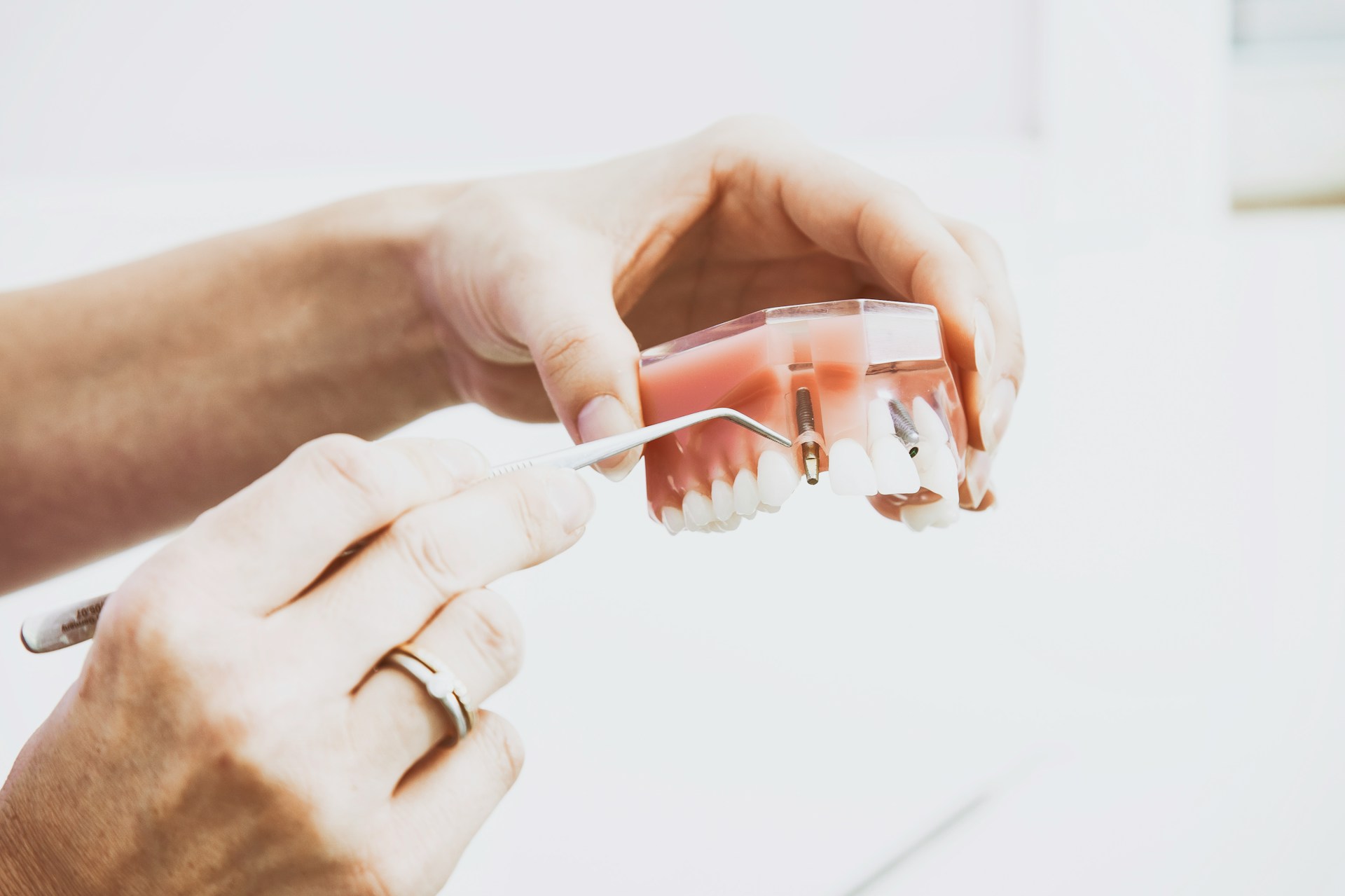 4 clínicas de Madrid para implantes dentales en personas mayores